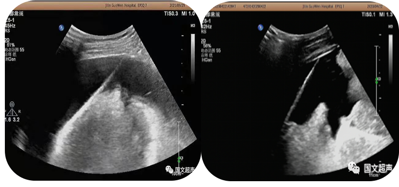 logiq e怎么读超声影像 ｜ 国文医院引进GE LOGIQ E11全“芯”高端全身超声_https://www.jmylbn.com_新闻资讯_第10张