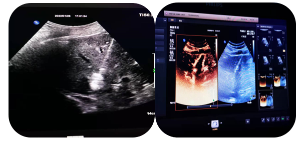logiq e怎么读超声影像 ｜ 国文医院引进GE LOGIQ E11全“芯”高端全身超声_https://www.jmylbn.com_新闻资讯_第19张