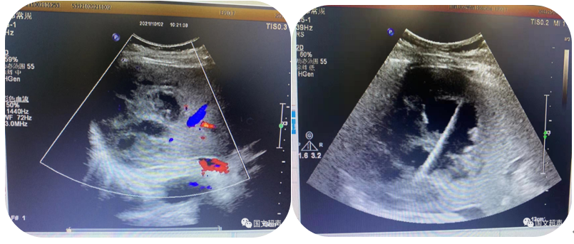 logiq e怎么读超声影像 ｜ 国文医院引进GE LOGIQ E11全“芯”高端全身超声_https://www.jmylbn.com_新闻资讯_第9张