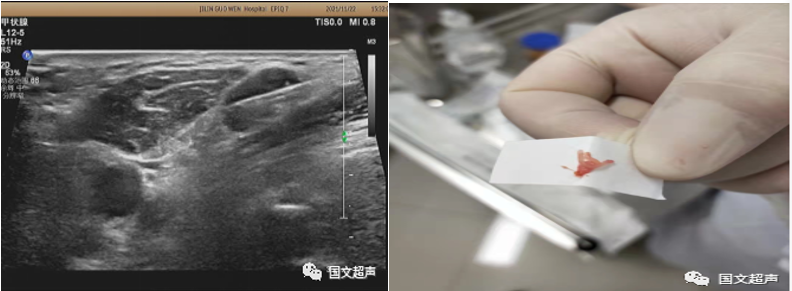 logiq e怎么读超声影像 ｜ 国文医院引进GE LOGIQ E11全“芯”高端全身超声_https://www.jmylbn.com_新闻资讯_第6张