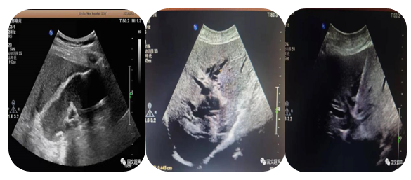 logiq e怎么读超声影像 ｜ 国文医院引进GE LOGIQ E11全“芯”高端全身超声_https://www.jmylbn.com_新闻资讯_第14张