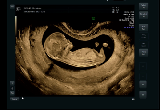 VOlusonE什么彩超机全球四维彩超高端设备丨美国GE Voluson E10-见证生命成长的每一时刻_https://www.jmylbn.com_新闻资讯_第3张