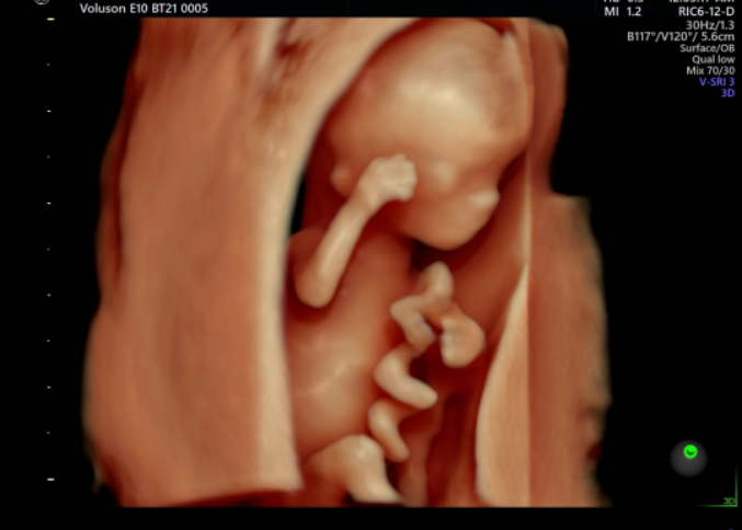 VOlusonE什么彩超机全球四维彩超高端设备丨美国GE Voluson E10-见证生命成长的每一时刻_https://www.jmylbn.com_新闻资讯_第4张