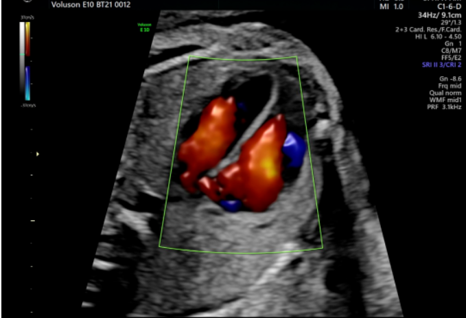 VOlusonE什么彩超机全球四维彩超高端设备丨美国GE Voluson E10-见证生命成长的每一时刻_https://www.jmylbn.com_新闻资讯_第5张