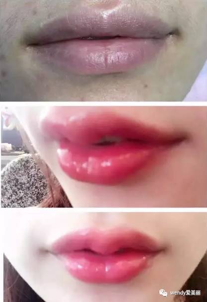 靠!丰唇后不是性感的厚嘴唇,而是红肿的香肠嘴!