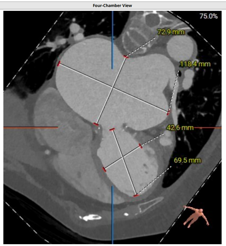 导丝怎么扩挑战高龄高危极限，引领微创“心”突破！大医二院赵昕教授团队使用Renatus®球扩瓣成功完成一例高难度经导管二尖瓣瓣中瓣置换术_https://www.jmylbn.com_新闻资讯_第6张