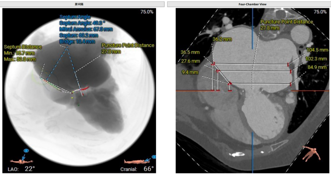 导丝怎么扩挑战高龄高危极限，引领微创“心”突破！大医二院赵昕教授团队使用Renatus®球扩瓣成功完成一例高难度经导管二尖瓣瓣中瓣置换术_https://www.jmylbn.com_新闻资讯_第5张