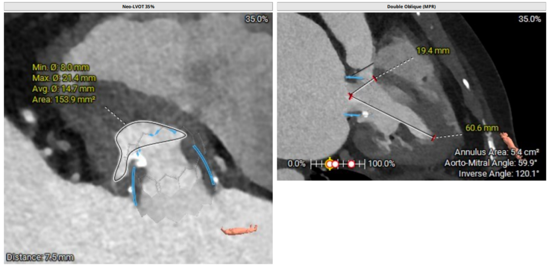导丝怎么扩挑战高龄高危极限，引领微创“心”突破！大医二院赵昕教授团队使用Renatus®球扩瓣成功完成一例高难度经导管二尖瓣瓣中瓣置换术_https://www.jmylbn.com_新闻资讯_第4张