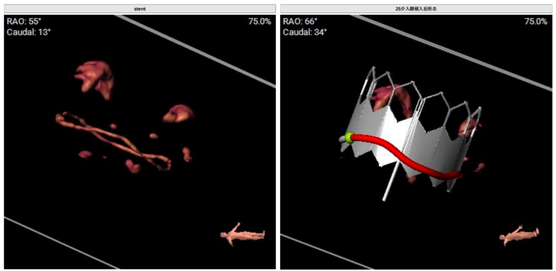 导丝怎么扩挑战高龄高危极限，引领微创“心”突破！大医二院赵昕教授团队使用Renatus®球扩瓣成功完成一例高难度经导管二尖瓣瓣中瓣置换术_https://www.jmylbn.com_新闻资讯_第3张