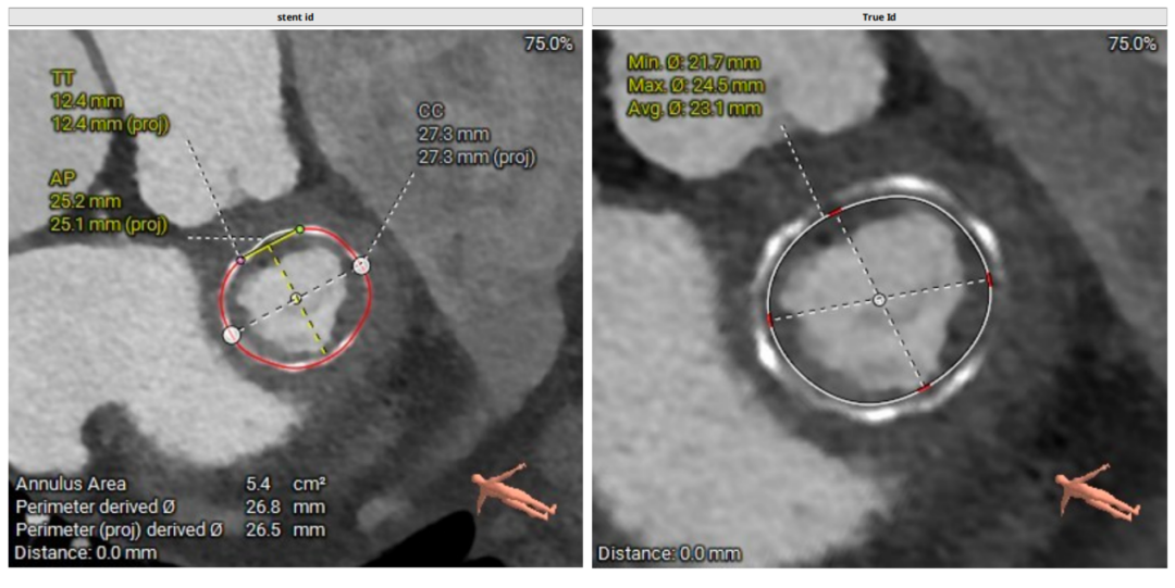 导丝怎么扩挑战高龄高危极限，引领微创“心”突破！大医二院赵昕教授团队使用Renatus®球扩瓣成功完成一例高难度经导管二尖瓣瓣中瓣置换术_https://www.jmylbn.com_新闻资讯_第2张