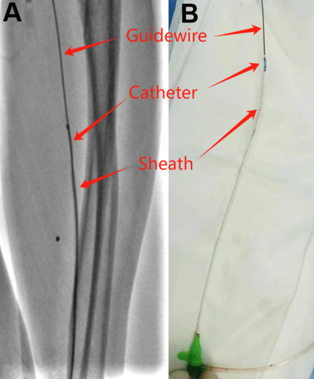 桡动脉鞘怎么读桡动脉鞘管拔不出来怎么办？（文后附精美秘籍彩图）_https://www.jmylbn.com_新闻资讯_第5张