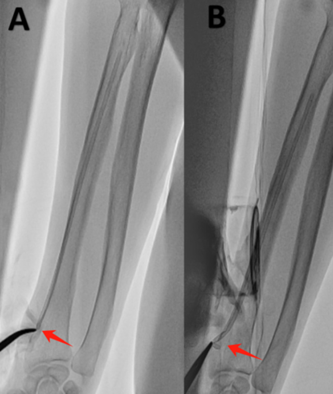 桡动脉鞘怎么读桡动脉鞘管拔不出来怎么办？（文后附精美秘籍彩图）_https://www.jmylbn.com_新闻资讯_第3张