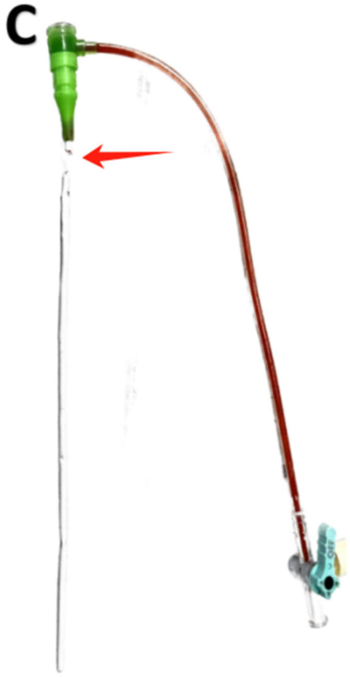 桡动脉鞘怎么读桡动脉鞘管拔不出来怎么办？（文后附精美秘籍彩图）_https://www.jmylbn.com_新闻资讯_第4张