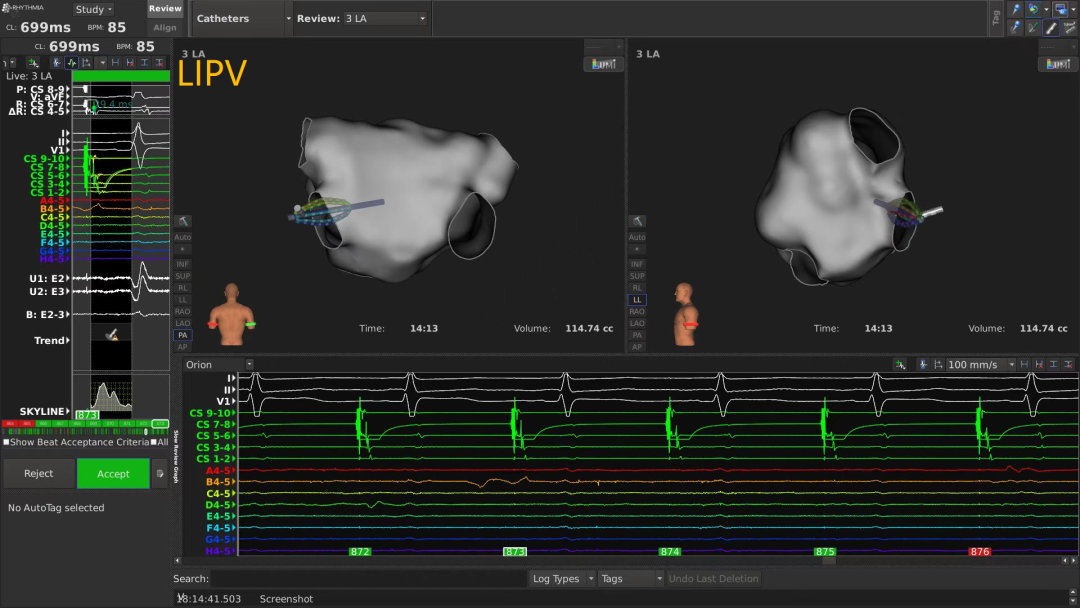 手术消融电极怎么用广州医科大学附属第二医院成功应用DIRECTSENSE™局部阻抗监测技术完成房颤射频消融手术_https://www.jmylbn.com_新闻资讯_第7张