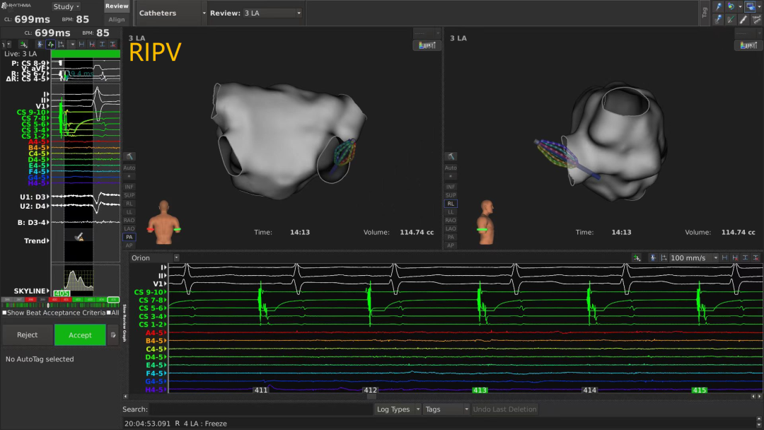 手术消融电极怎么用广州医科大学附属第二医院成功应用DIRECTSENSE™局部阻抗监测技术完成房颤射频消融手术_https://www.jmylbn.com_新闻资讯_第4张