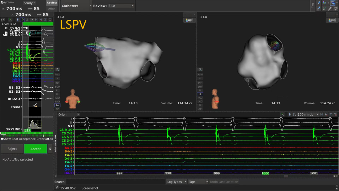 手术消融电极怎么用广州医科大学附属第二医院成功应用DIRECTSENSE™局部阻抗监测技术完成房颤射频消融手术_https://www.jmylbn.com_新闻资讯_第6张
