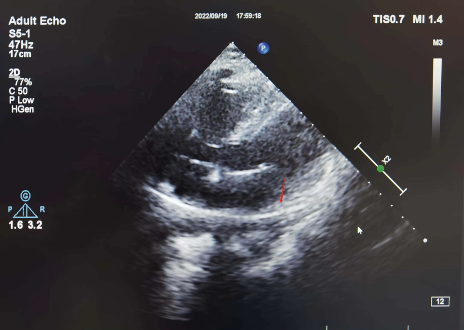 手术电极是什么意思超声引导，东莞市人民医院心内科团队“零射线”植入心系列双腔起搏器_https://www.jmylbn.com_新闻资讯_第4张