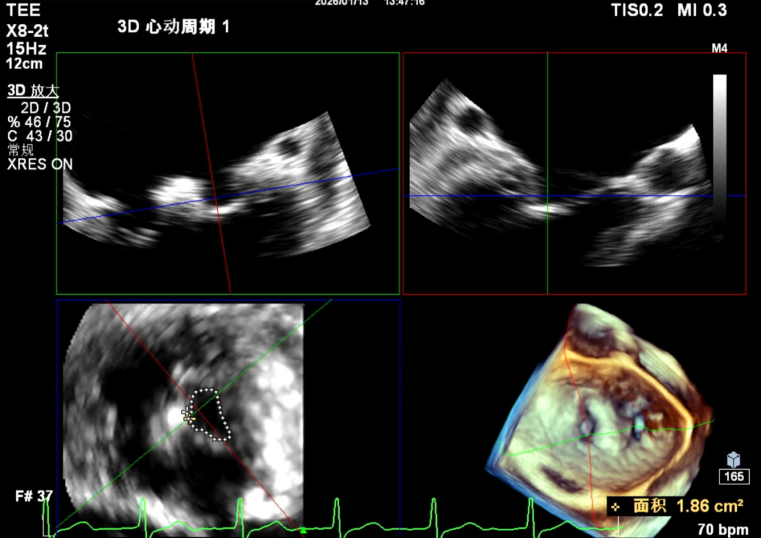 怎么上穿刺鞘攻克巨大左房伴转位穿刺难关！温医大附一院周浩教授团队创新应用“导丝定位+可调弯鞘”技术完成高难度TEER手术_https://www.jmylbn.com_新闻资讯_第38张