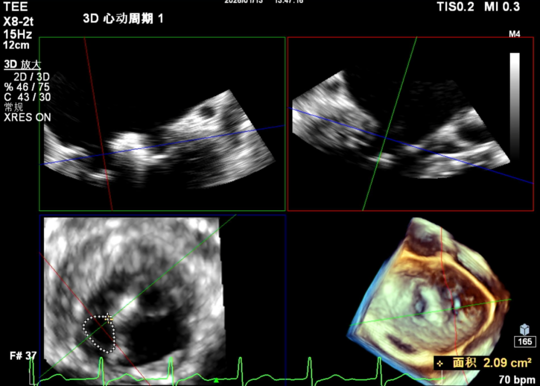 怎么上穿刺鞘攻克巨大左房伴转位穿刺难关！温医大附一院周浩教授团队创新应用“导丝定位+可调弯鞘”技术完成高难度TEER手术_https://www.jmylbn.com_新闻资讯_第39张