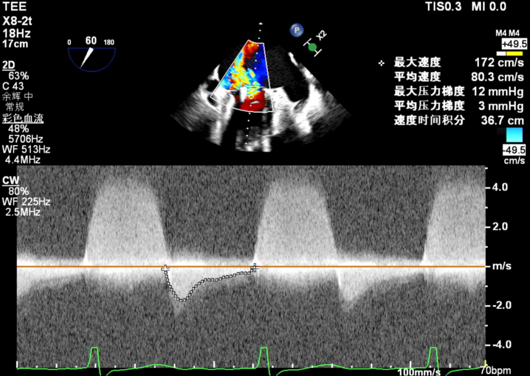 怎么上穿刺鞘攻克巨大左房伴转位穿刺难关！温医大附一院周浩教授团队创新应用“导丝定位+可调弯鞘”技术完成高难度TEER手术_https://www.jmylbn.com_新闻资讯_第32张