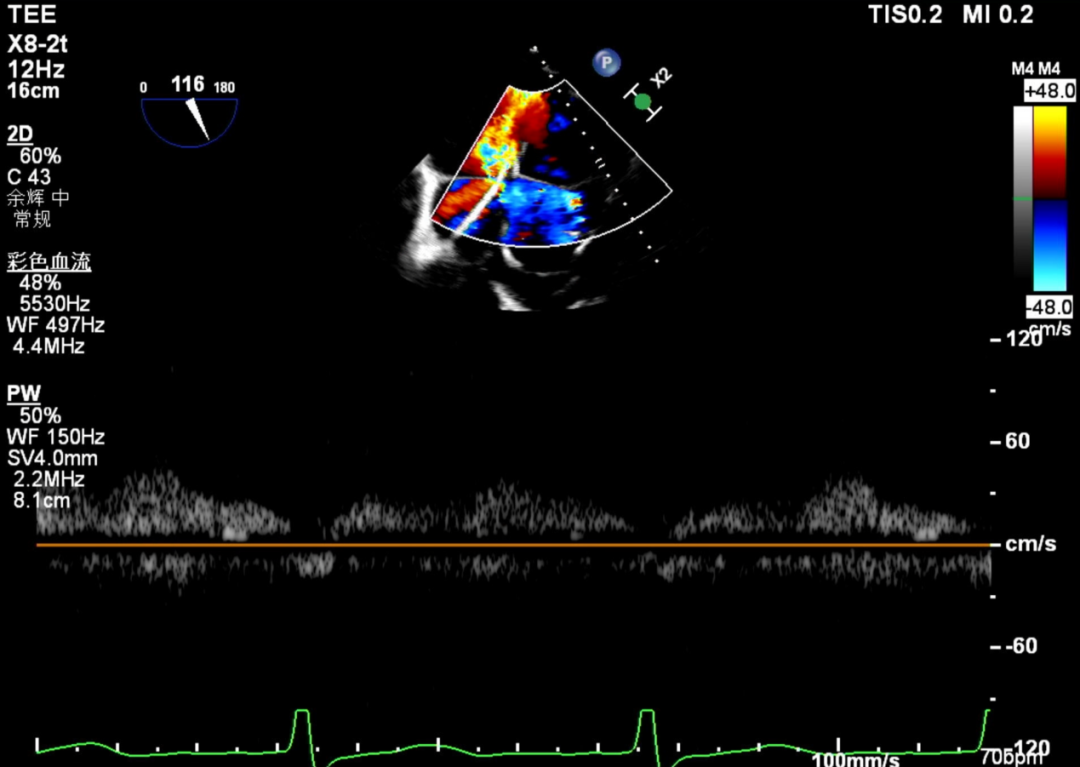 怎么上穿刺鞘攻克巨大左房伴转位穿刺难关！温医大附一院周浩教授团队创新应用“导丝定位+可调弯鞘”技术完成高难度TEER手术_https://www.jmylbn.com_新闻资讯_第41张