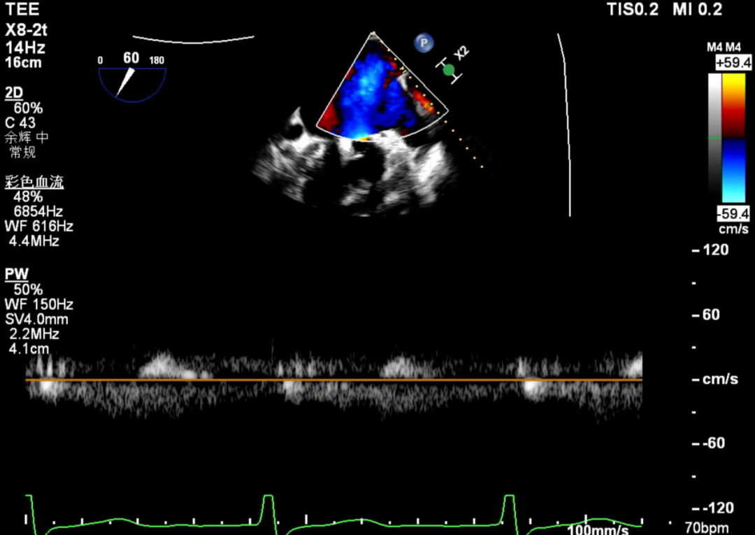 怎么上穿刺鞘攻克巨大左房伴转位穿刺难关！温医大附一院周浩教授团队创新应用“导丝定位+可调弯鞘”技术完成高难度TEER手术_https://www.jmylbn.com_新闻资讯_第40张