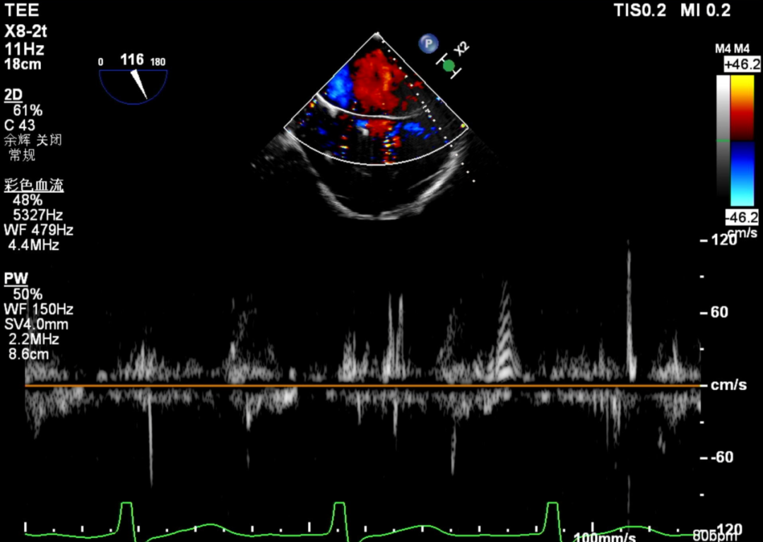 怎么上穿刺鞘攻克巨大左房伴转位穿刺难关！温医大附一院周浩教授团队创新应用“导丝定位+可调弯鞘”技术完成高难度TEER手术_https://www.jmylbn.com_新闻资讯_第11张