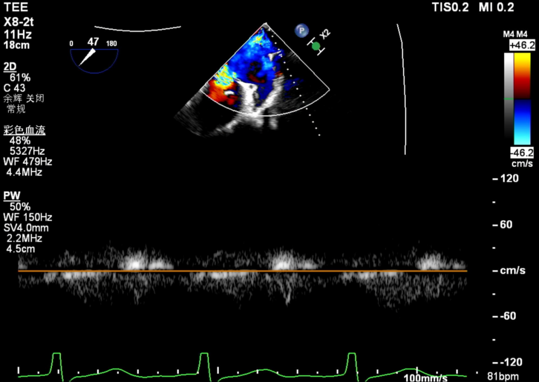怎么上穿刺鞘攻克巨大左房伴转位穿刺难关！温医大附一院周浩教授团队创新应用“导丝定位+可调弯鞘”技术完成高难度TEER手术_https://www.jmylbn.com_新闻资讯_第10张