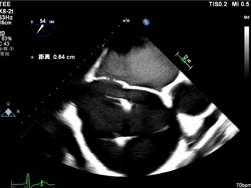 怎么上穿刺鞘攻克巨大左房伴转位穿刺难关！温医大附一院周浩教授团队创新应用“导丝定位+可调弯鞘”技术完成高难度TEER手术_https://www.jmylbn.com_新闻资讯_第43张