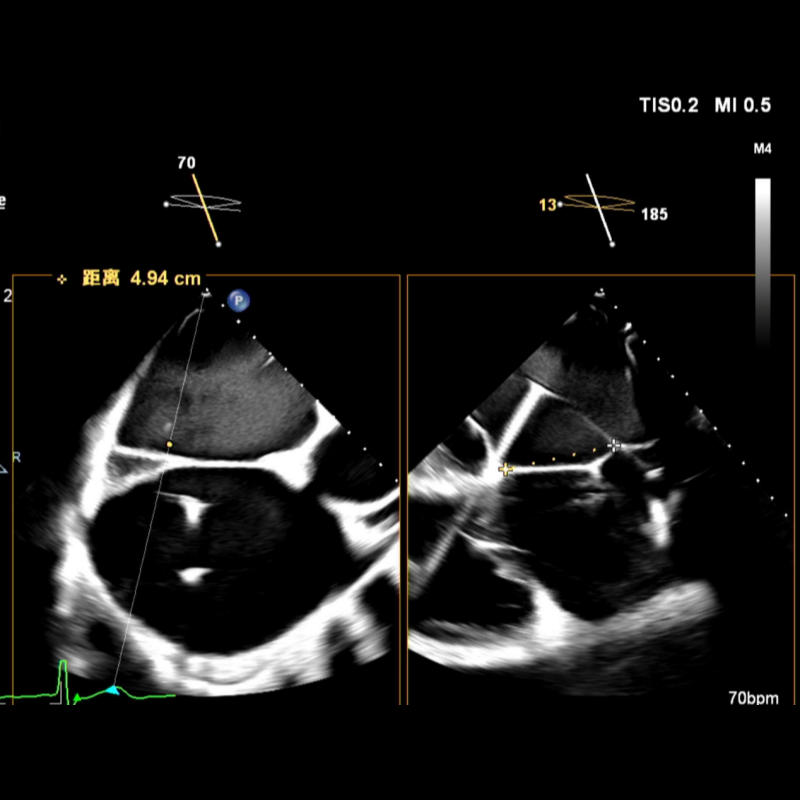 怎么上穿刺鞘攻克巨大左房伴转位穿刺难关！温医大附一院周浩教授团队创新应用“导丝定位+可调弯鞘”技术完成高难度TEER手术_https://www.jmylbn.com_新闻资讯_第19张