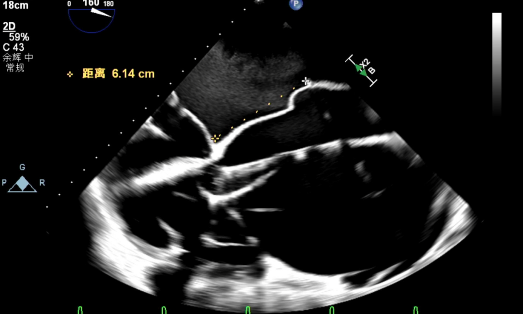 怎么上穿刺鞘攻克巨大左房伴转位穿刺难关！温医大附一院周浩教授团队创新应用“导丝定位+可调弯鞘”技术完成高难度TEER手术_https://www.jmylbn.com_新闻资讯_第13张