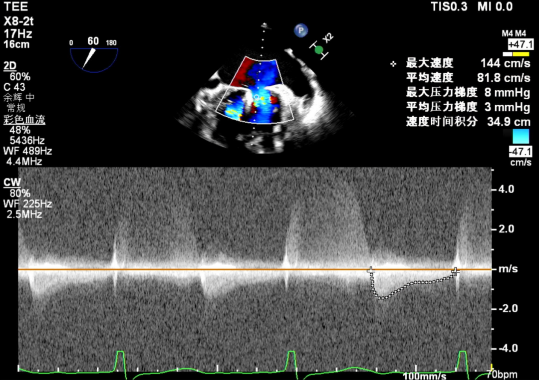 怎么上穿刺鞘攻克巨大左房伴转位穿刺难关！温医大附一院周浩教授团队创新应用“导丝定位+可调弯鞘”技术完成高难度TEER手术_https://www.jmylbn.com_新闻资讯_第37张