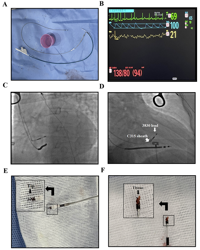血管鞘组是什么傅国胜／叶炀教授团队创新技术发表《Heart Rhythm》：无钢丝引导电极-鞘介导心肌活检术在CIEDS植入期间可行、安全_https://www.jmylbn.com_新闻资讯_第4张