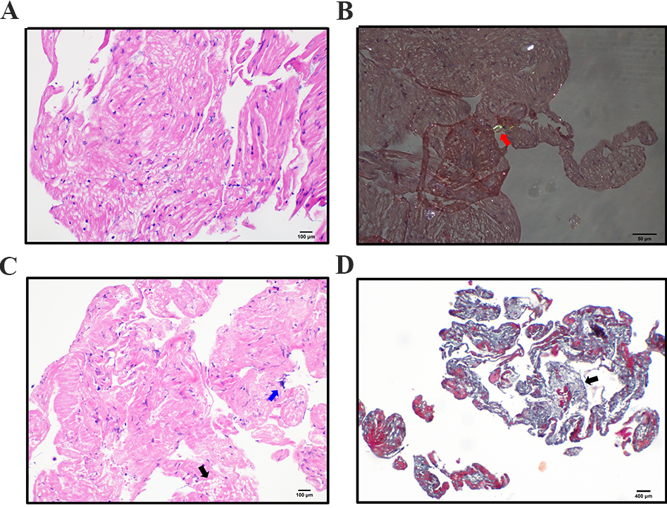 血管鞘组是什么傅国胜／叶炀教授团队创新技术发表《Heart Rhythm》：无钢丝引导电极-鞘介导心肌活检术在CIEDS植入期间可行、安全_https://www.jmylbn.com_新闻资讯_第7张