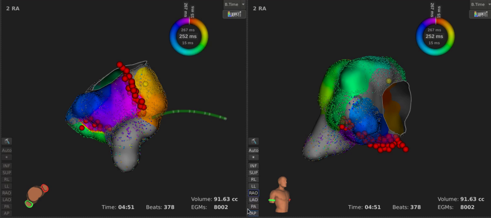 手术消融电极怎么用梅州市人民医院（黄塘医院）成功应用Rhythmia三维标测系统及DIRECTSENSE™技术完成外科术后房扑射频消融手术_https://www.jmylbn.com_新闻资讯_第8张