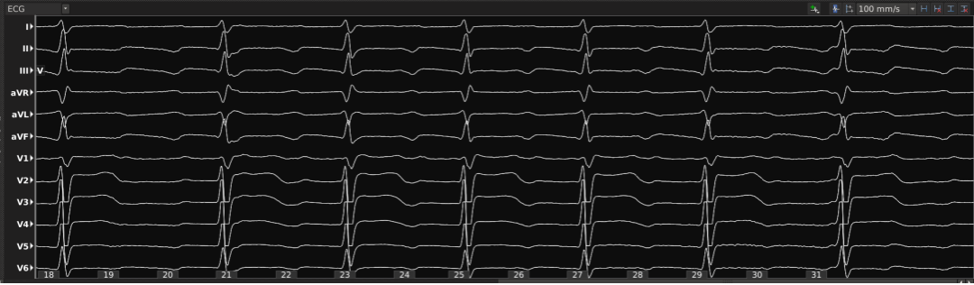 手术消融电极怎么用梅州市人民医院（黄塘医院）成功应用Rhythmia三维标测系统及DIRECTSENSE™技术完成外科术后房扑射频消融手术_https://www.jmylbn.com_新闻资讯_第2张