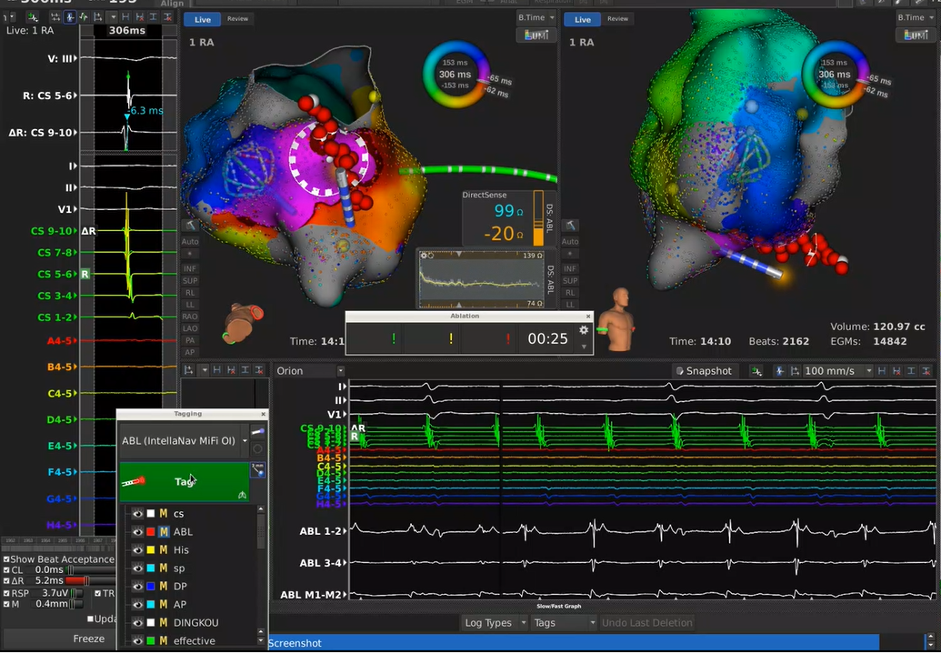 手术消融电极怎么用梅州市人民医院（黄塘医院）成功应用Rhythmia三维标测系统及DIRECTSENSE™技术完成外科术后房扑射频消融手术_https://www.jmylbn.com_新闻资讯_第6张