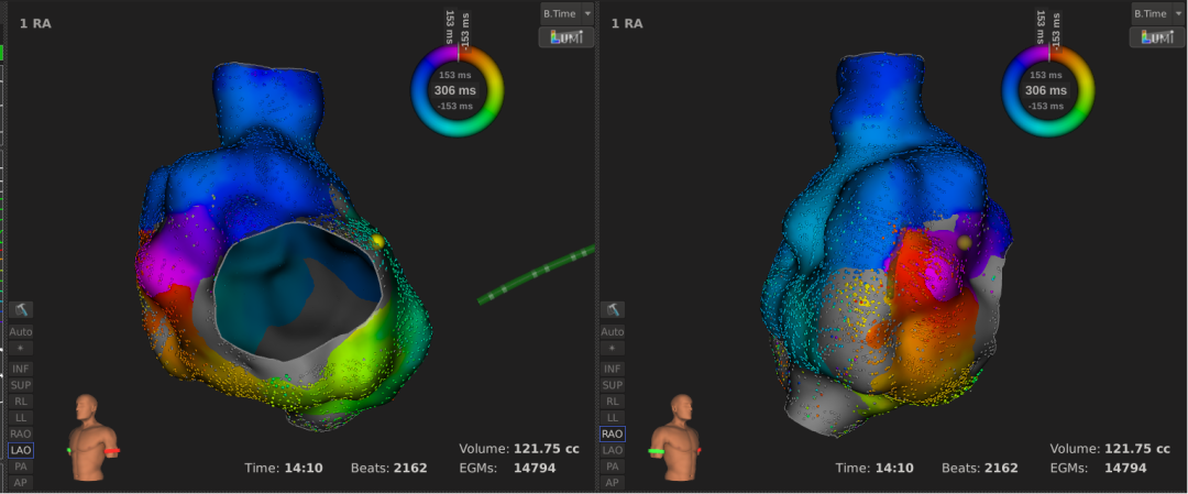 手术消融电极怎么用梅州市人民医院（黄塘医院）成功应用Rhythmia三维标测系统及DIRECTSENSE™技术完成外科术后房扑射频消融手术_https://www.jmylbn.com_新闻资讯_第4张