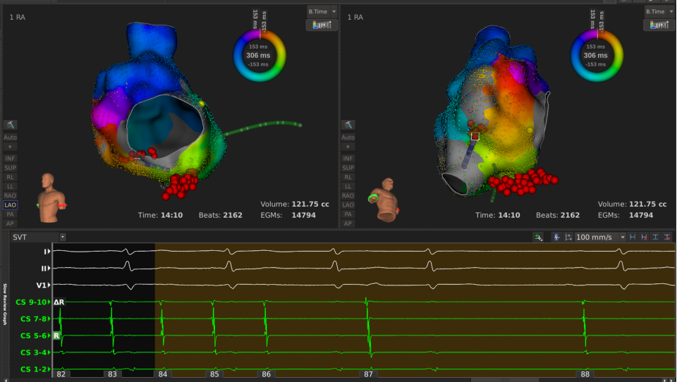 手术消融电极怎么用梅州市人民医院（黄塘医院）成功应用Rhythmia三维标测系统及DIRECTSENSE™技术完成外科术后房扑射频消融手术_https://www.jmylbn.com_新闻资讯_第7张