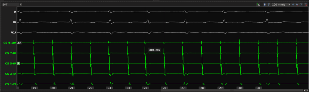 手术消融电极怎么用梅州市人民医院（黄塘医院）成功应用Rhythmia三维标测系统及DIRECTSENSE™技术完成外科术后房扑射频消融手术_https://www.jmylbn.com_新闻资讯_第3张