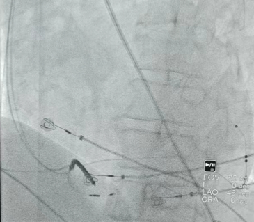 消融电极医院怎么收费节律重整 收获心生｜北京大学第一医院心内科团队率先使用左室主动电极行房室结消融+LOT-CRT一站式手术_https://www.jmylbn.com_新闻资讯_第3张