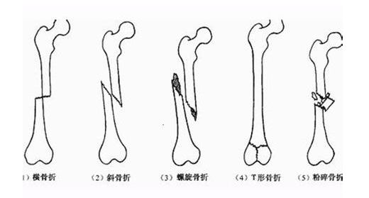 嵌插骨折图片图片