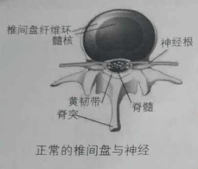 腰疼就是腰椎间盘突出症？你错了(图6)