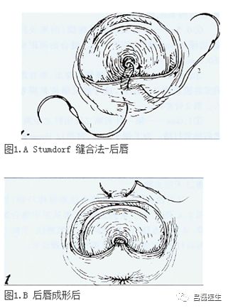 宫颈锥切手术及缝合方法