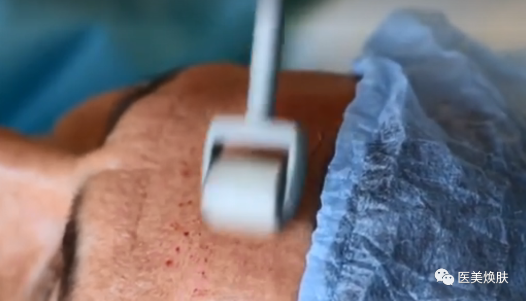 怎么消毒滚针滚针操作的方法及注意事项_https://www.jmylbn.com_新闻资讯_第3张