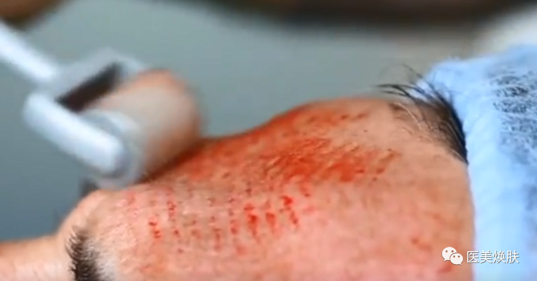 怎么消毒滚针滚针操作的方法及注意事项_https://www.jmylbn.com_新闻资讯_第4张