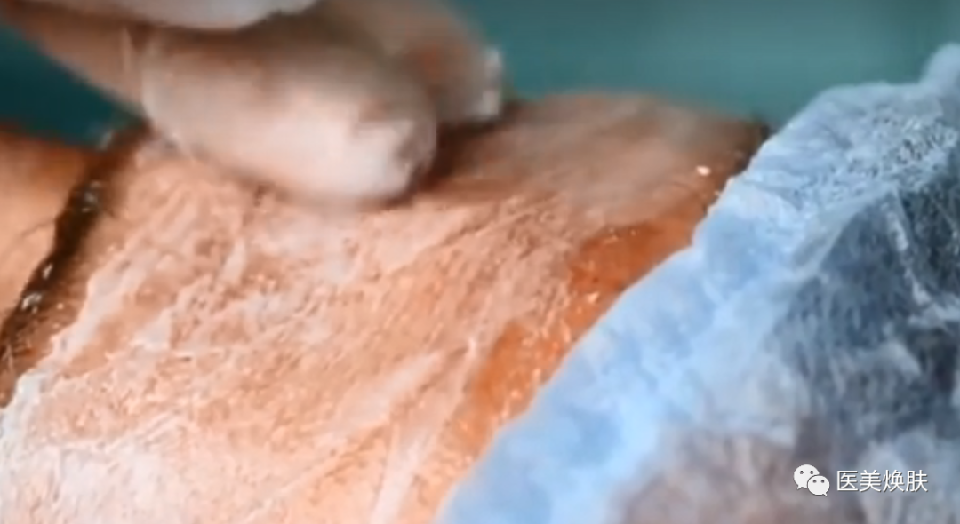 怎么消毒滚针滚针操作的方法及注意事项_https://www.jmylbn.com_新闻资讯_第2张