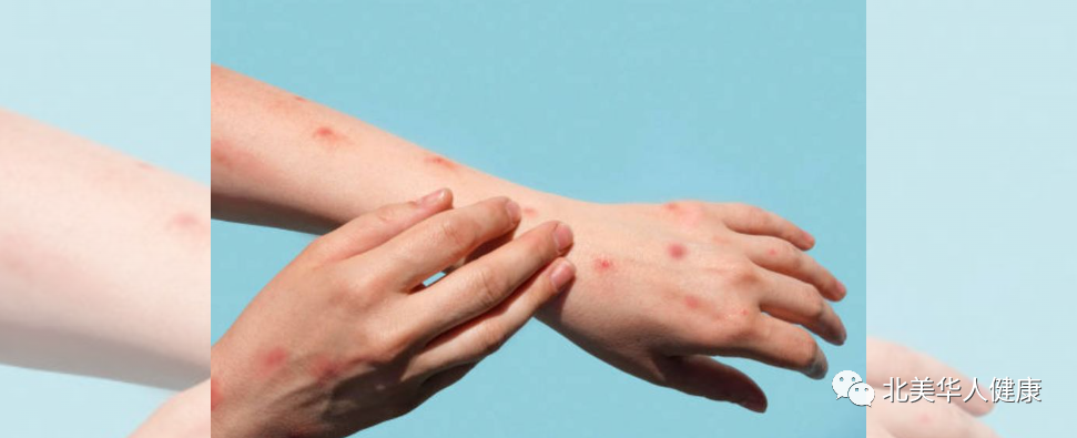 猴痘确诊病例快速上升，全球病例破千，加拿大四省78例-Centre for New Immigrant Well-Being (CNIW)