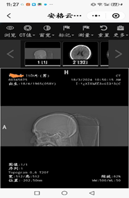为什么x光片用胶片“云胶片”正式上线啦——用手机随时随地就能看X光片、CT、核磁共振_https://www.jmylbn.com_新闻资讯_第13张