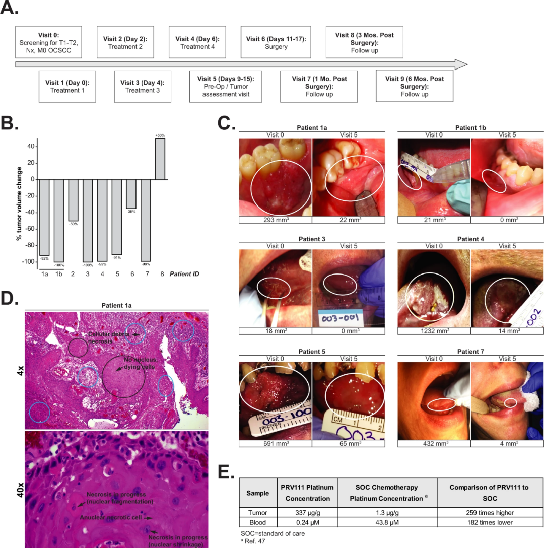Nature Communications：  纳米工程化顺铂递送系统治疗口腔癌的临床研究